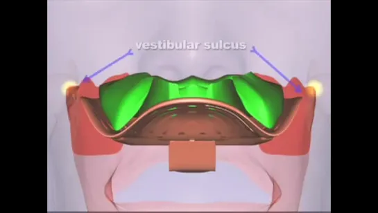 Оттиск. Massad Tray Sizing for Maxillary Impression