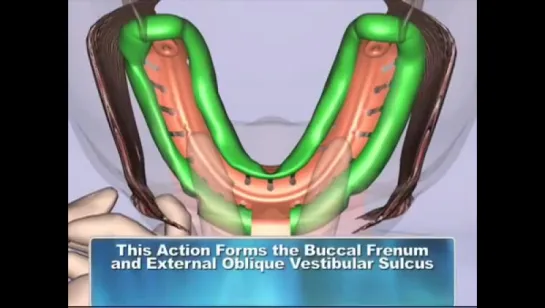 Оттиск. Massad Tray Border Molding for Mandibular Impression