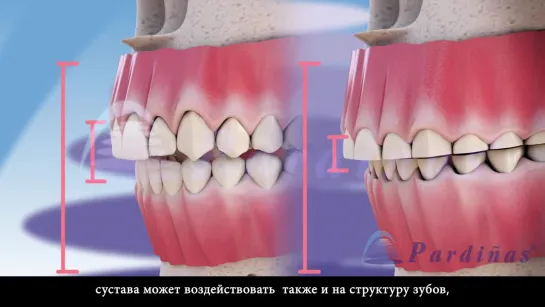 Бруксизм и височно-нижнечелюстная дисфункция ©Пропедевтика гнатологии.