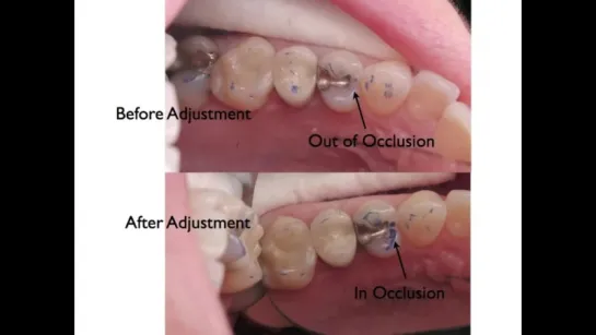 Occlusion for the Dental Staff