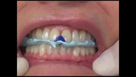 The Occlusal Splint - Part 1. Окклюзионные шины.