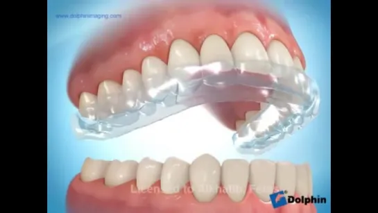 Maxillary Splint Bruxism. Шина при бруксизме.