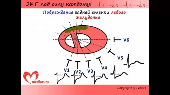 Школа ЭКГ. Урок 10