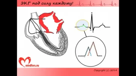 Школа ЭКГ. Урок 8