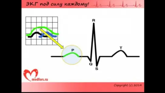 Школа ЭКГ. Урок 2