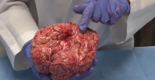 2. The Normal Unfixed Brain  Neuroanatomy Video Lab - Brain Dissections