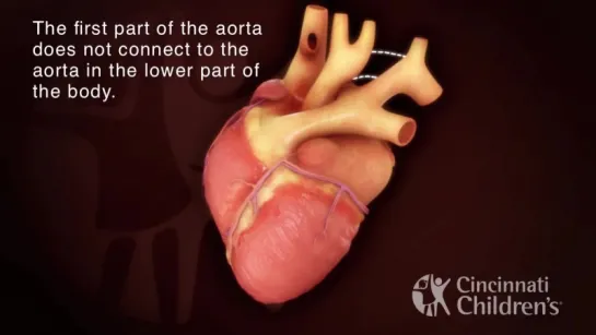 Interrupted Aortic Arch − Ventricular Septic Defect