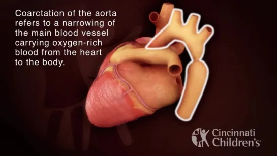 Coarctation of the Aorta