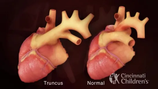 Truncus Arteriosus