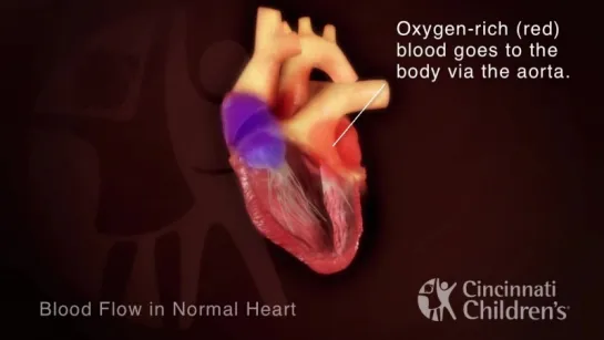 Transposition of the Great Arteries