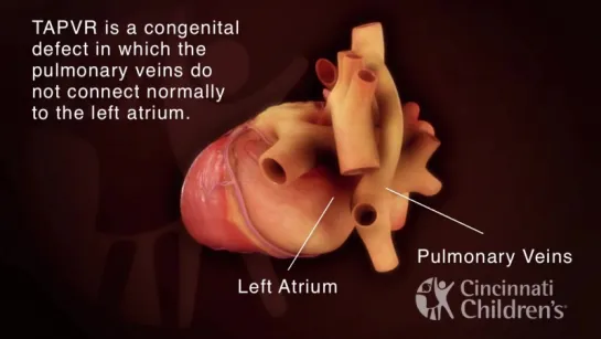 Total Anomalous Pulmonary Venous Return