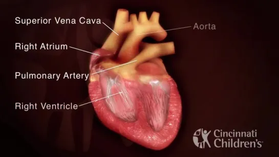 Tetralogy of Fallot