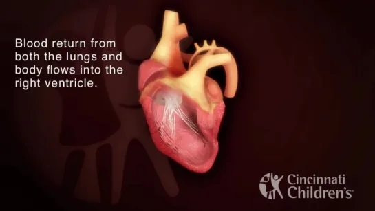 Hypoplastic Left Heart Syndrome (HLHS)