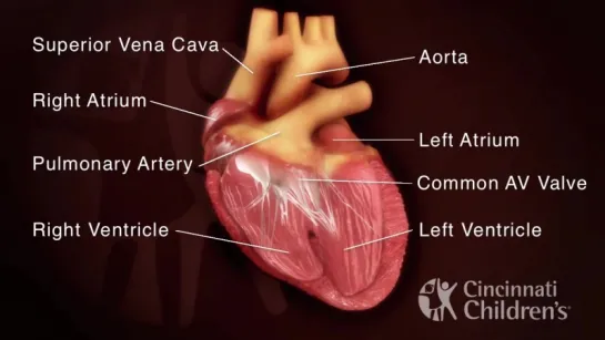 Atrioventricular Septal Defect - AV Canal