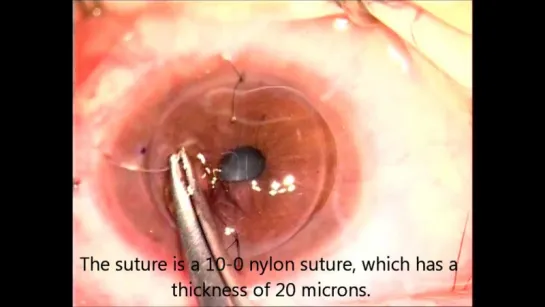 Corneal Transplantation for Acanthamoeba Keratitis