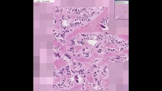 36. Histopathology Bone--Osteosarcoma