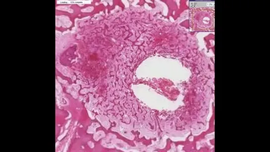 35.Histopathology Bone--Osteoid osteoma