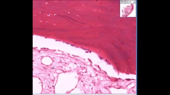 34. Histopathology Bone--Osteoarthritis, subchondral cyst