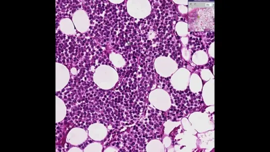 33. Histopathology Bone--Multiple myeloma