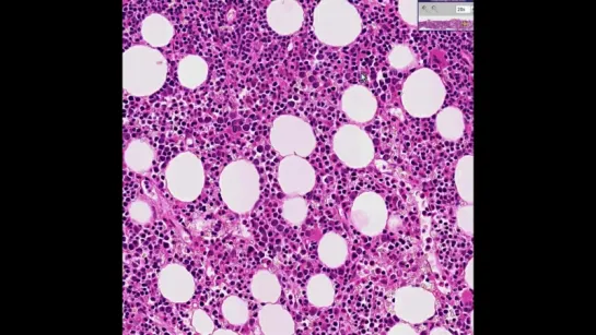 32.Histopathology Bone marrow --Follicular lymphoma