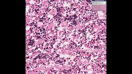 31.Histopathology Bone marrow--Erythroid hyperplasia