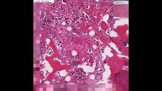 30.Histopathology Bone Marrow--Chronic idiopathic myelofibrosis