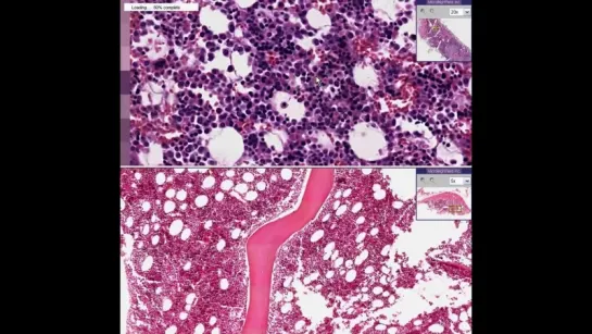 29.Histopathology Bone marrow -- adenocarcinoma, metastatic