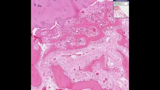 28.Histopathology Bone--Hyperparathyroidism