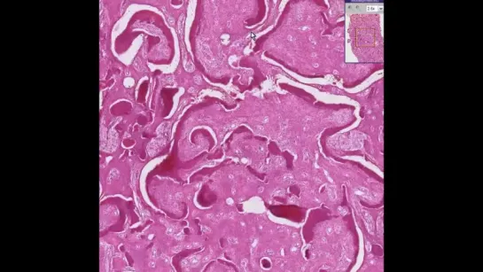 27. Histopathology Bone--Fibrous dysplasia