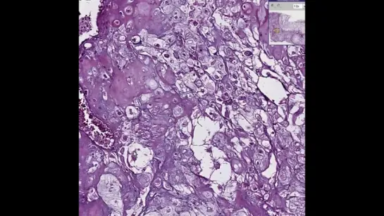 26.Histopathology Bone--Chondroma