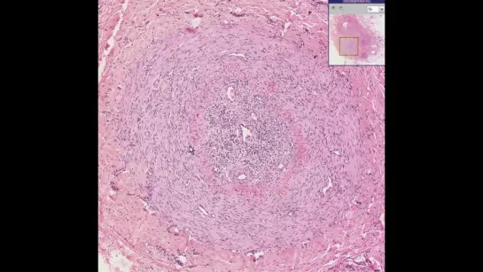 25. Blood vessels--Buergers disease