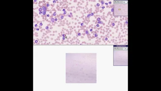 24.Blood --Chronic myelogenous leukemia