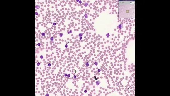 23.Blood--Chronic lymphocytic leukemia