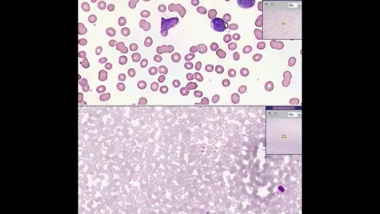 22.Blood --Acute leukemia