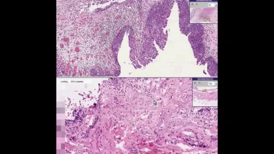 21.Bladder--Urothelial carcinoma (transitional cell carcinoma) in-situ