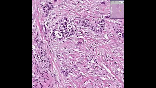 20.Bladder --Urothelial carcinoma Grade III