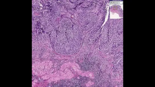 19.Bladder --Urothelial carcinoma Grade I