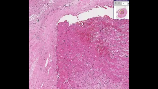 18.Artery --Thrombus, Atherosclerotic plaque