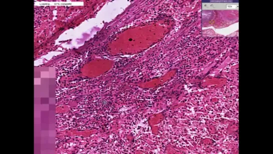 16.Appendix--Peri-appendiceal abscess