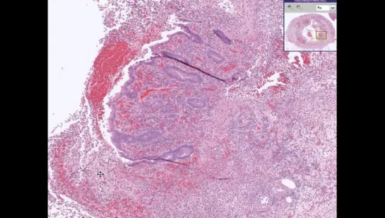 15.Appendix --Acute appendicitis2