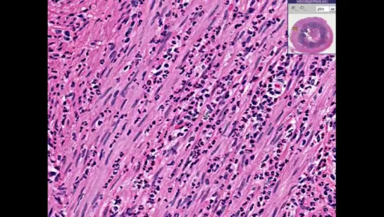 14.Appendix-Acute Appendicitis