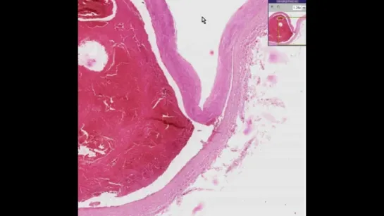 13.Histopathology Aorta--Dissection, cystic medial degeneration