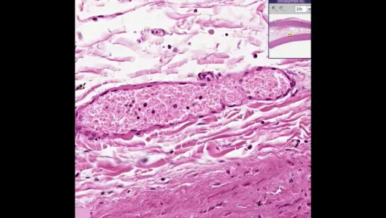 12.Aorta--Atherosclerosis with fatty streak