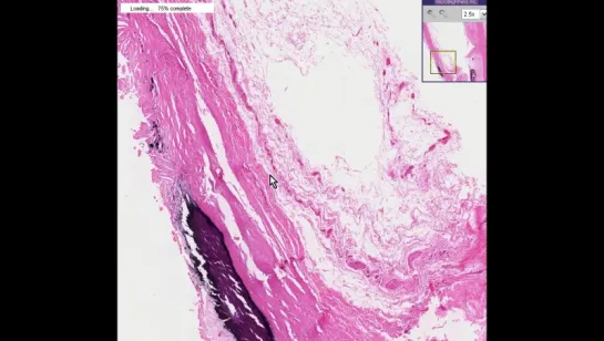 11. Aorta --Atherosclerosis