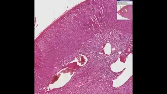 9.Histopathology Adrenal--Pheochromocytoma