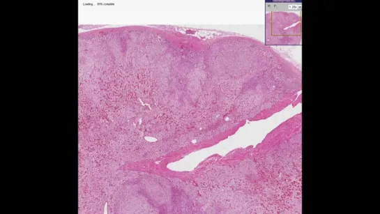 8.Histopathology Adrenal--Nodular hyperplasia