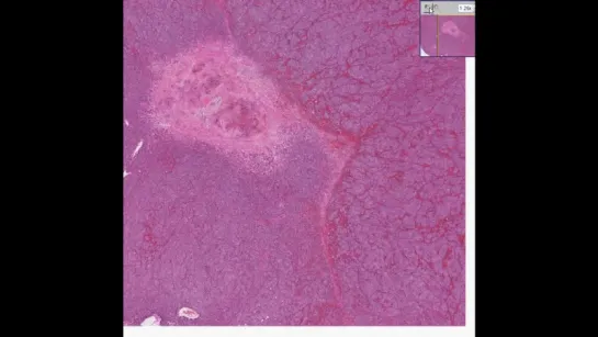 7.Histopathology Adrenal--Neuroblastoma