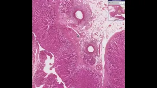 5.Histopathology Adrenal gland --Polyarteritis