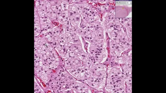 3.Histopathology Adrenal--Cortical adenoma