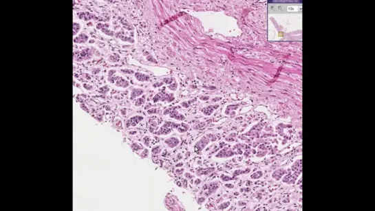 2.Histopathology Adrenal--Atrophy